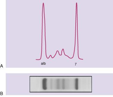Serum protein electrophoresis showing a monoclonal (M) protein.