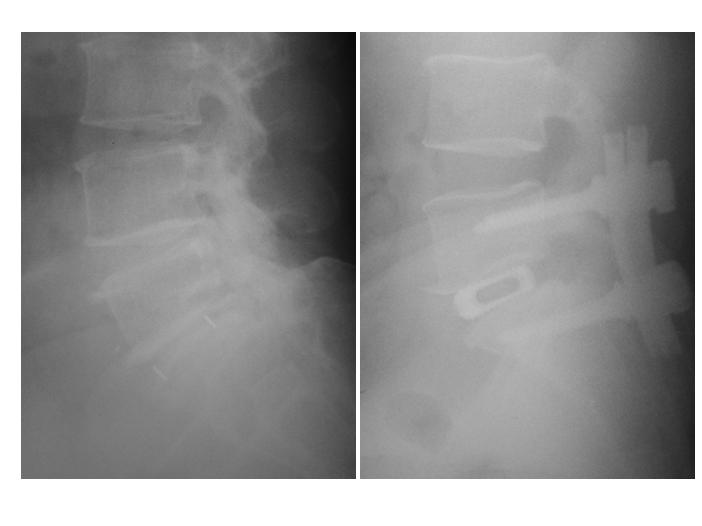 or 신경공협착의판단 임상증상이동반된중등도 (MRI