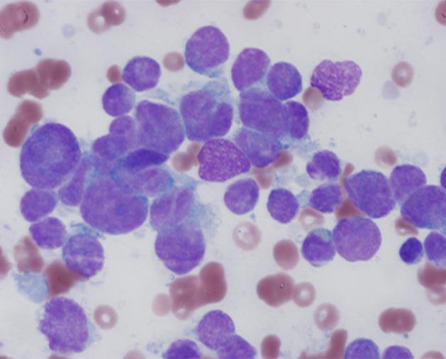 조선영외 : 골수에침윤된원발불명의소세포암종 1 예 405 Fig. 1. Bone marrow aspiration smears show small to medium sized malignant cells which were clustering, with high N/C ratio and scanty cytoplasm (Wright stain, x1,000).