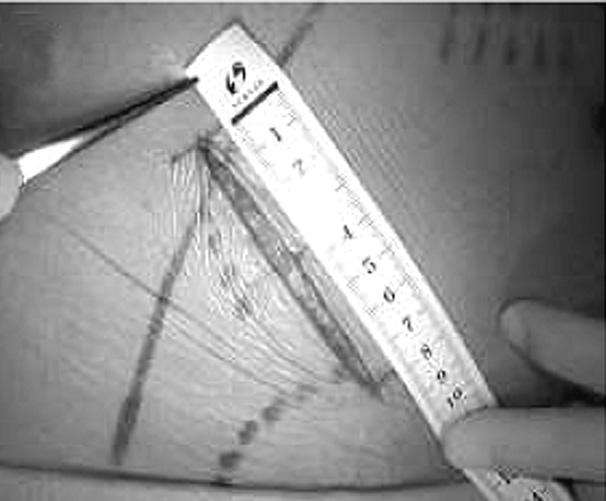 bladder (thin arrow) were marked preoperatively using ultrasound (B) A 7~8 cm incision