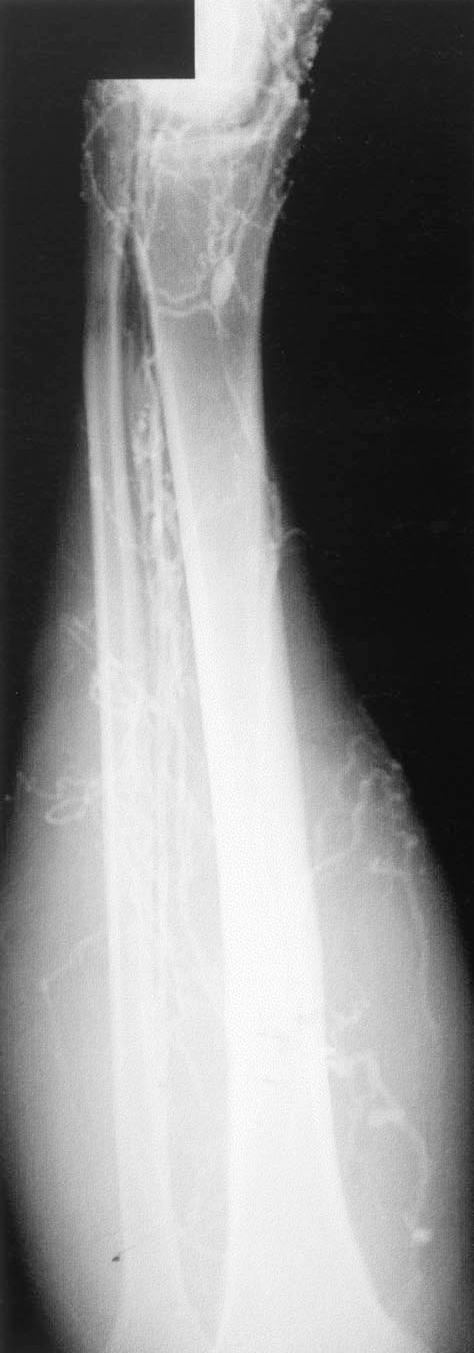 Fig. 5. Venograms of both legs show obstructions of multiple levels of deep veins of both lower extremities and resultant collaterals and varices.