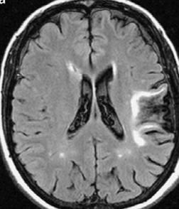 Leukoencephalopathy involving at least 25% of the total WM (beginning to include: become confluent in four regions, i.e., frontal bilaterally, and parietal bilaterally) PT, parietotemporal; TO,
