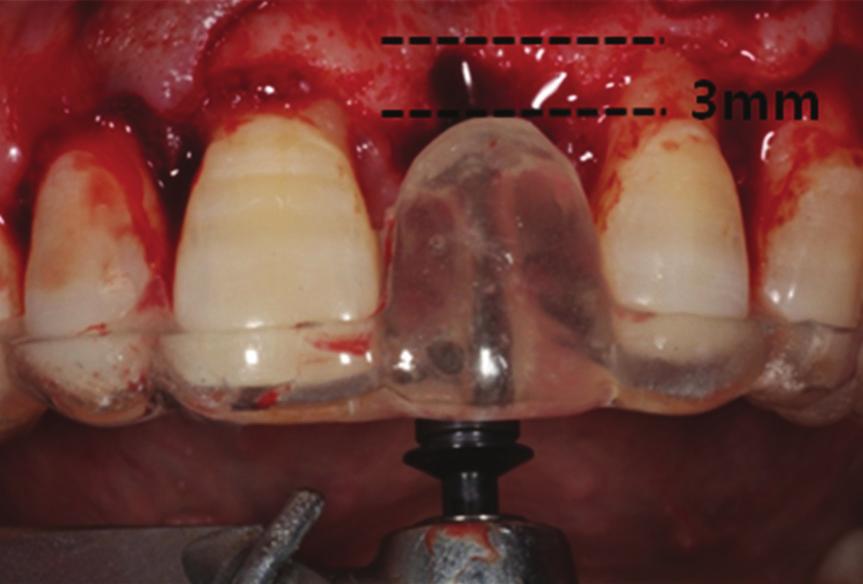 Timing of the soft-tissue conditioning process in esthetic sites.