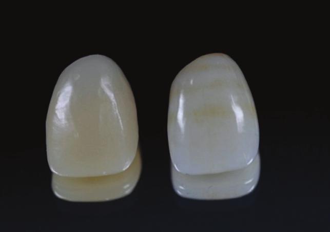 Case Reports Fig. 20. Zirconia crown final insertion. Fig. 19. Left: resin cap for adaptation. Right: zirconia crown for final prosthesis.