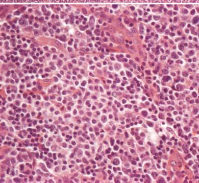 cells. There is a well-defined mantle area between the tumor cells and the residual germinal center.