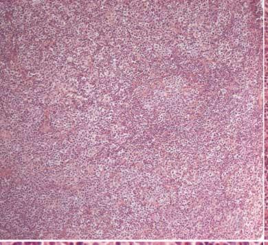(D) There are scattered blastoid cells without sheet formation. 으로위축된림프여포구조가관찰되었다 (Fig. 1A).