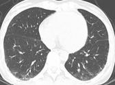 - 대한내과학회지 : 제 73 권부록 2 호 2007 - Clinicopathological findings in the subsets of pulmonary-renal