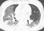 pulmonary-renal syndrome systemic lupus erythematosus, mixed cryoglobulinemia, Henoch-Schonlein