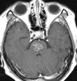 : Behcet s disease Polyneuropathy Guillain-Barre syndrome Necrotizing vasculitis Myopathy