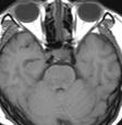 좌측상하지근력약화현병력 : 약 10 년전베체트병진단후간헐적으로치료받아오던중수일전상기증상발생 MRI T1W T1W/CE T2W CSF findings: WBC: 8 /mm 3,