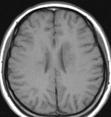 14 Cerebral peduncle 11 Tegmentum 4 Quadrigeminal plate 1