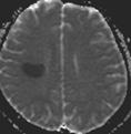 - 대한내과학회지 : 제 73 권부록 2 호 2007 - neuropsychiatric manifestations of Central nervous system Peripheral nervous system Aseptic meningitis Acute inflammatory demyelinating Cerebrovascular disease
