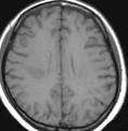 Movement disorder (chorea) Myasthenia gravis Myelopathy Cranial neuropathy Seizure disorder Plexopathy Acute confusional state Polyneuropathy Anxiety disorder Cognitive dysfunction Mood disorder