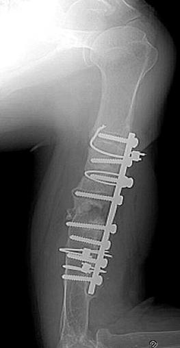 accident 3 years ago, initially had an internal fixation, but a