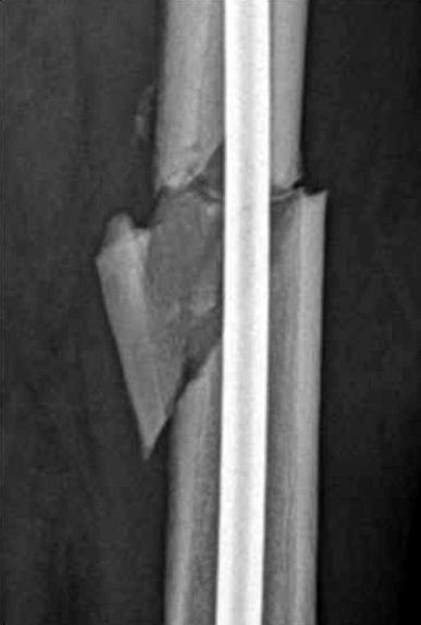 50 안기찬, 김윤준, 최장석, 서승석, 곽희철, 정대원, 정동우 Fig. 4. (A) Complicated case Lateral radiograph showing initial post-op finding with large amount of displacement.