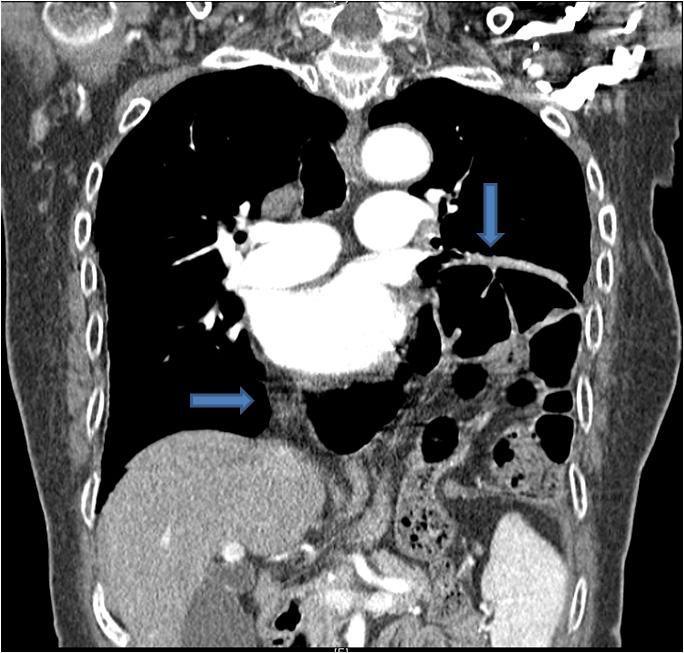 2011-09-27 Abdonmen X ray : Fecal material in rectum. Diaphragmatic hernia, Lt.