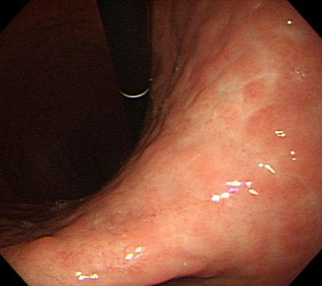 - Wook Jin Lee, et al. A case of API2-MALT1 translocation-positive gastric MALT lymphoma - 은정상소견이었다. 내시경및조직검사소견 : 상부위장관내시경검사상분문부에서부터체부의소만쪽에미만성위축성변화가관찰되었고, 다발성의궤양및점막결절이보였다.