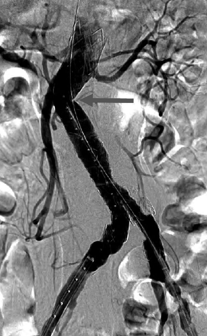 However, left proximal limb stent-graft (arrow) showed significant stenosis due to angulation. C, D.