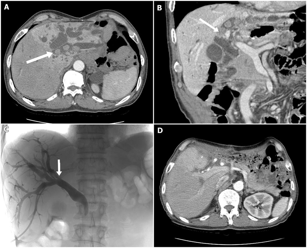 (C) After left lateral sectionectomy, remnant intrahepatic stones and bile duct dilatation are not observed in abdominal CT scan. Fig. 2. A case of left hemihepatectomy.