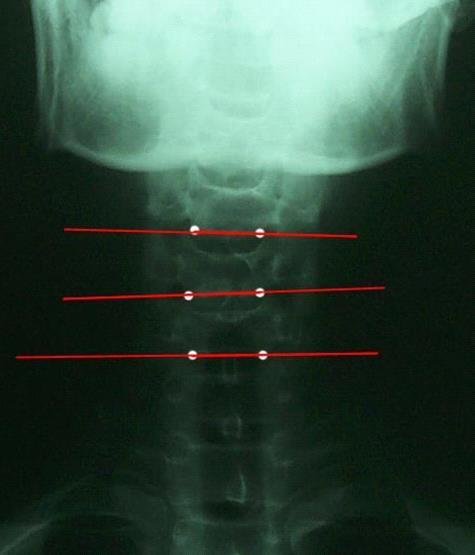 Full Spine Technique Protocol (Diagnosis) X-ray check ( 영상분석 ) 경추 (Cervical) : AP - Cervical