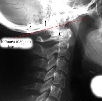 Full Spine Technique Protocol (Diagnosis) X-ray check ( 영상분석 ) 경추 (Cervical) : Lateral - Cervical Foramen magnum line 후두과 ( occipital