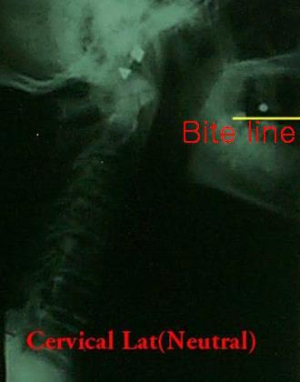 Full Spine Technique Protocol (Diagnosis) X-ray check ( 영상분석 ) 경추 (Cervical) : Lateral - Cervical Bite