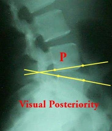 Full Spine Technique Protocol (Diagnosis) X-ray check ( 영상분석 ) 요추 (Lumbar) Visual Posteriority 척추전반에걸쳐척추의하나또는일부가후방으로