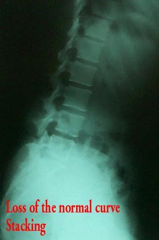 Full Spine Technique Protocol (Diagnosis) X-ray check ( 영상분석 ) 요추 (Lumbar) Vertebral Stacking