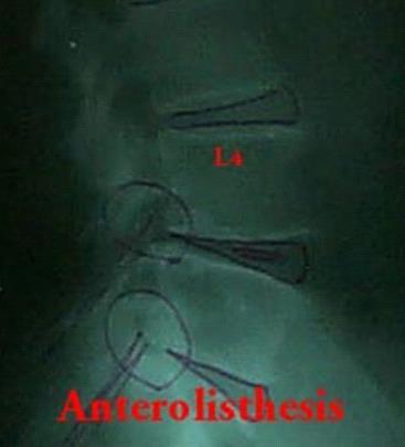 Full Spine Technique Protocol (Diagnosis) X-ray check ( 영상분석 ) 요추 (Lumbar)