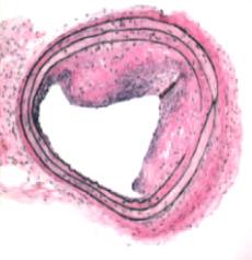 37 단순금속스텐트의경우이러한철망의내피화 (endotheliazation) 에대략 1달정도소요되는것으로알려져있으나경동맥과관련하여명확한임상자료는부족하다. 37 자가팽창스텐트를설치한후 6 개월째혈관내초음파를시행한연구에서는대부분이내피화되었다.