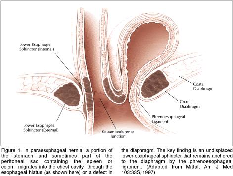 Paraesophageal hernia http://www.