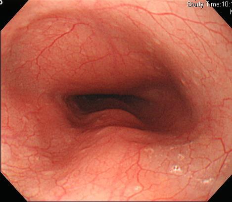 Indentations of the esophagus