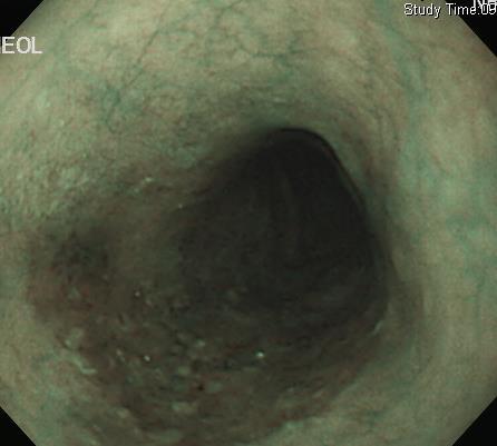 Esophageal cancer - 2 mm
