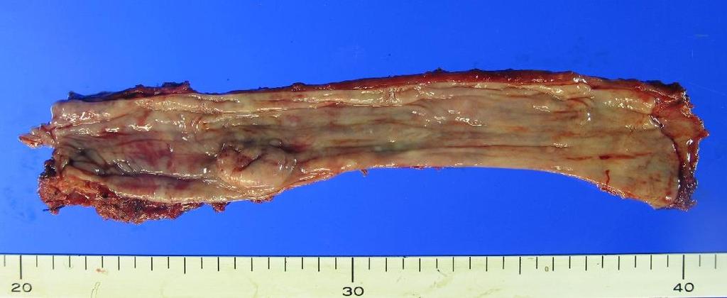 Esophageal cancer after surgery for EGC Invasive squamous