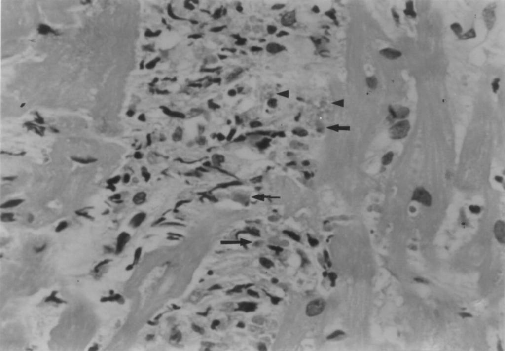 B Fig. 2. Microscopic findings of the endomyocardial biopsy.