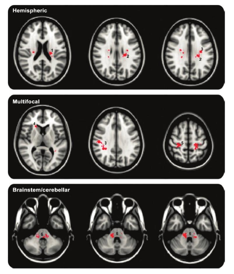 ARTICLE R E V I E W 임상단독증후군에서뇌병변위치에따른다발성경화증으로전환예측 04 Location of brain lesions predicts conversion of clinically isolated syndromes to multiple sclerosis Giorgio A, Battaglini M, Roca MA, et al.