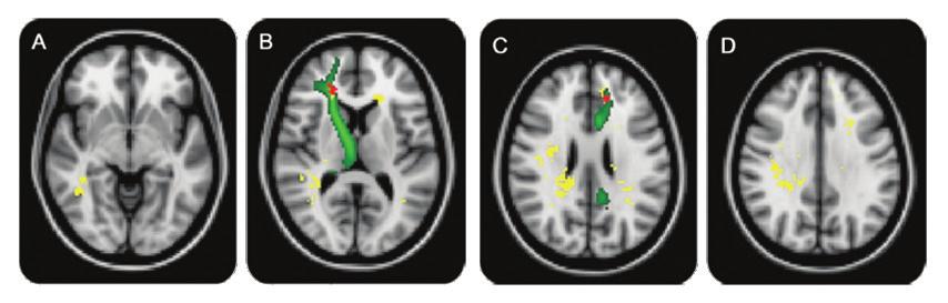 THE WINDOW OF MULTIPLE SCLEROSIS 여부는대체로 MRI 검사에서의백질병변존재유무에따라구분된다. 그러나백질병변위치에따라다발성경화증으로의전환에차이가있는지는아직명확히확인되지않았다. 본연구는대단위임상단독증후군환자군을 1년간추적조사하여뇌병변의해부학적특정부위가다발성경화증으로의전환과연관성이있는지알아보았다.