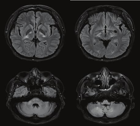 THE WINDOW OF MULTIPLE SCLEROSIS 서서히진행하는보행장애로내원한 38 세남성환자 김호진 국립암센터신경과 증례 38세남성환자로 2005년 ( 당시 30세 ) 처음양쪽하지위약감으로뇌, 척수 MRI를포함여러검사를시행했으나특이소견이없어치료를받지않았다.