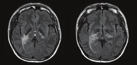 THE WINDOW OF MULTIPLE SCLEROSIS 그림 2. 추적뇌 MRI T2 FLAIR 결과 REVIEW CASE 28 29 Q3 환자에게추가로시행할검사는어떤것이있는가?