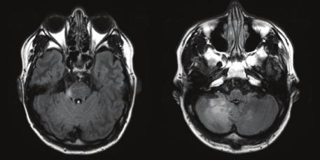 (adrenoleukodystrophy), 비타민 B12 결핍등의질환에대한감별이필요하다고판단하여검사를진행하였다.