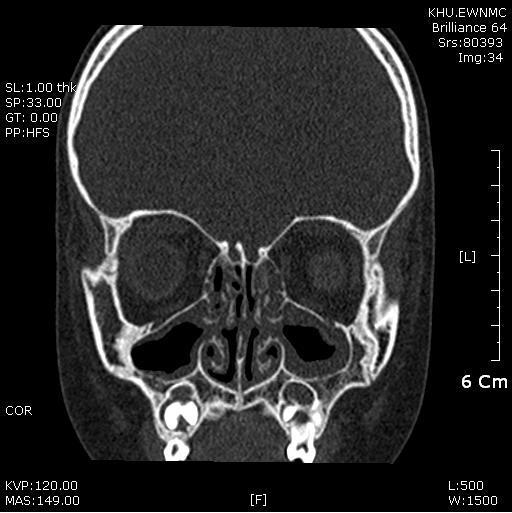 한방안이비인후피부과학회지제 27 권제 3 호 (2014 년 8 월 ) Fig, 1. 2009.01.29 Before treatment, mucosal edema, nasal congestion and watery discharge. Fig. 4. 2009.03.