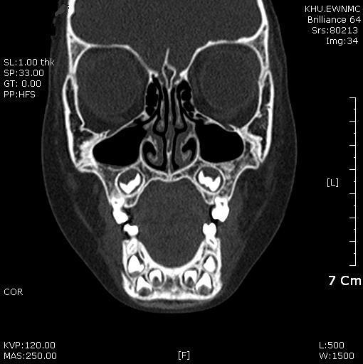 Fig. 5. 2009.01.29 Before treatment, mucosal edema, nasal congestion, watery discharge. Fig. 3. 2009.01.29 Before treatment, inflammatory change result in obstruction of bilateral middle meatus.