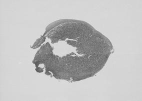 - 대한내과학회지 : 제 70 권부록 2 호 2006 - Figure 1. The initial biopsy of hypopharygeal mass shows diffuse lymphoid infiltrate with coagulative necrosis and ulcer (H&E stain, 40). Figure 2.