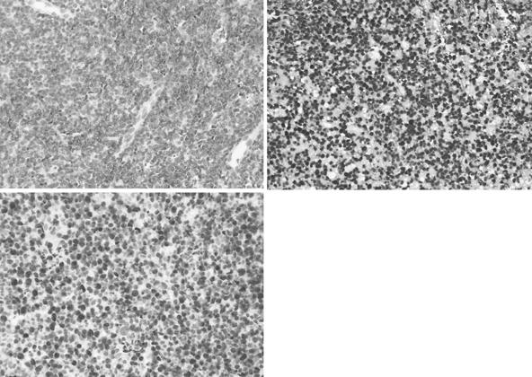 (C) Ki-67 labelling index of 95% ( 400) are typical of the CD56(+), extranodal NK/T-cell lymphoma of nasal type ( 400). Figure 4.