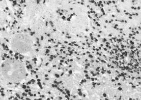 - 대한내과학회지 : 제 70 권부록 2 호 2006 - Figure 6. Immunostain for in situ hybridization for EBV encoded RNA(EBER) shows strong positive signals in nearly all tumor cell nuclei ( 400).