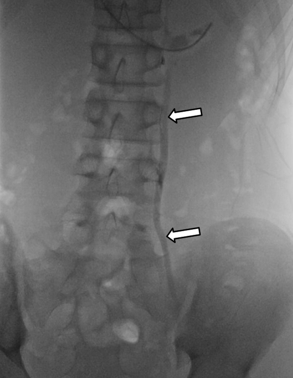 정계정맥류의인터벤션치료 A B C D Fig. 3. Type III varicocele.