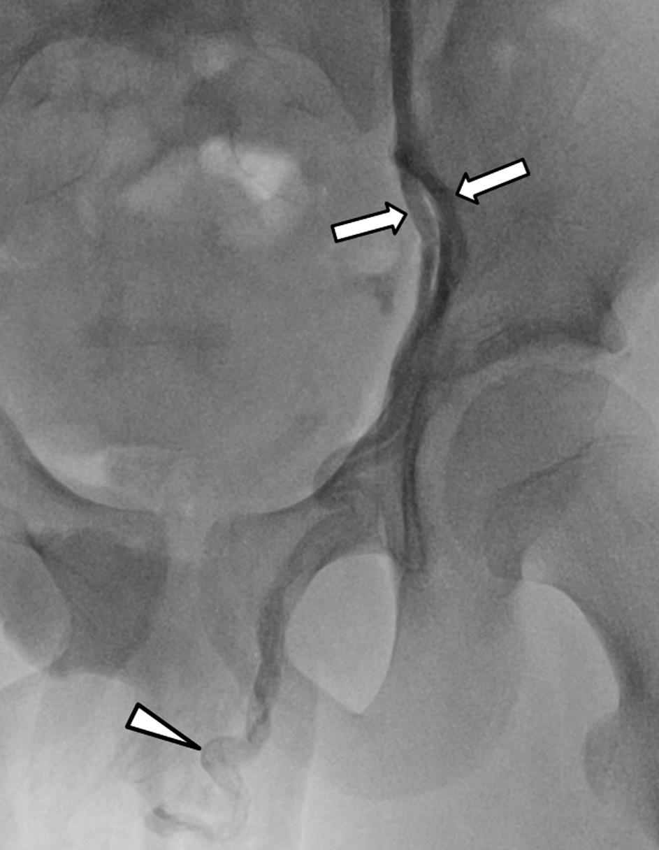 The testicular vein shows duplication (arrows) in its distal part (B).