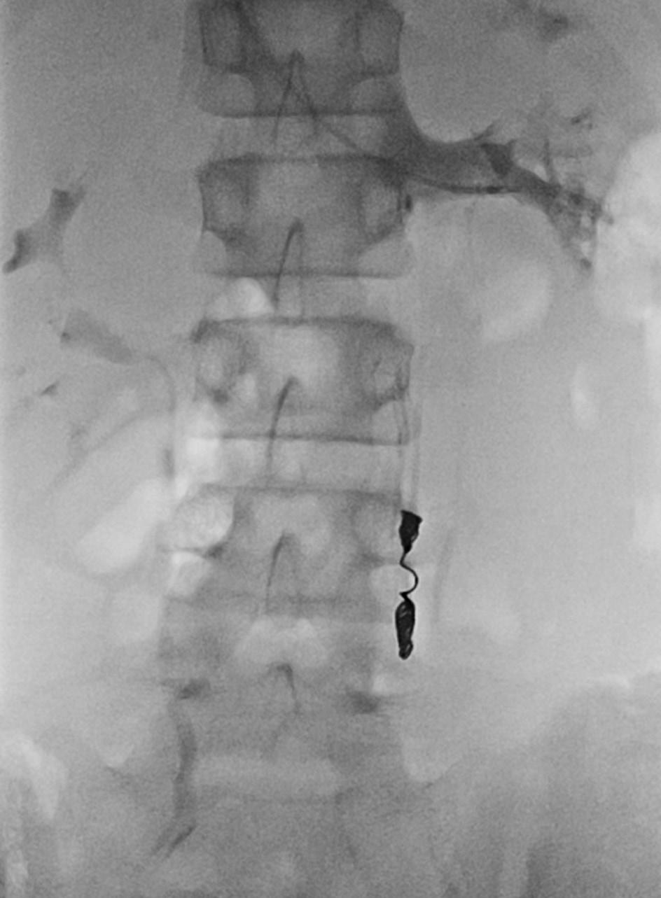 The distal testicular vein is embolized with coils and treated with