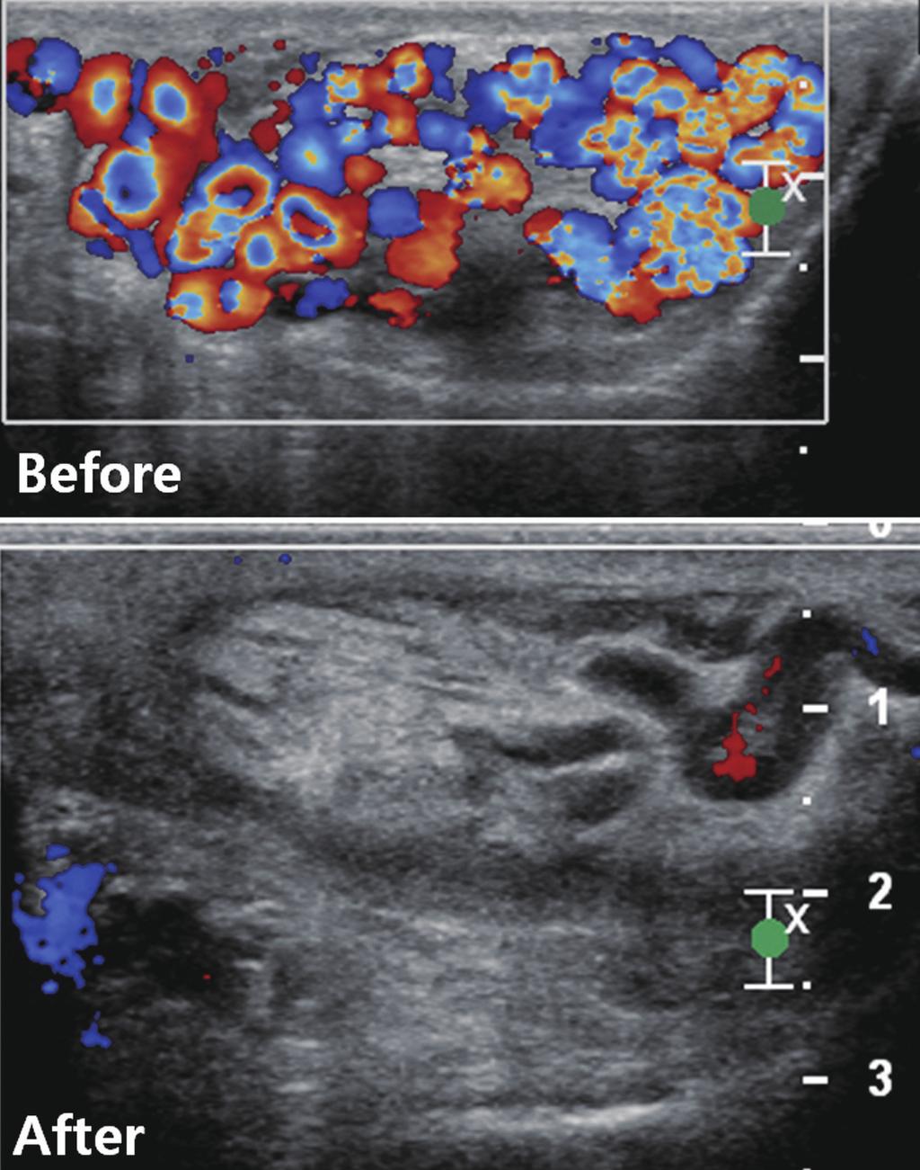 Left renal venogram shows reflux of contrast medium into the tortuous collateral vein (arrows).