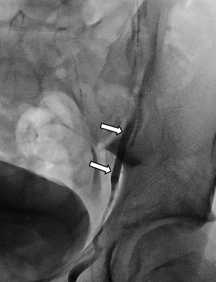 The collateral vein (arrows) is connected with the probable testicular vein (arrowheads). C.